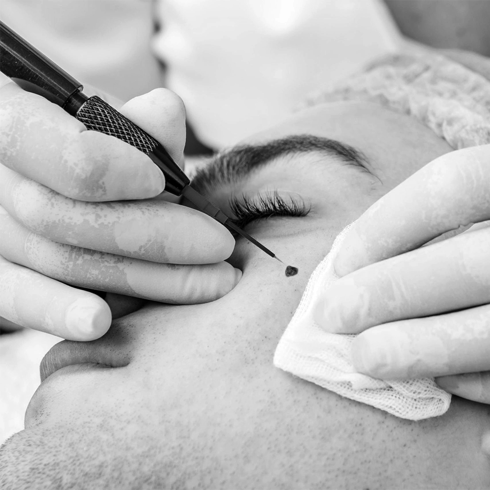 Black and white thumbnail image showcasing the Lamprobe treatment for skin irregularities.