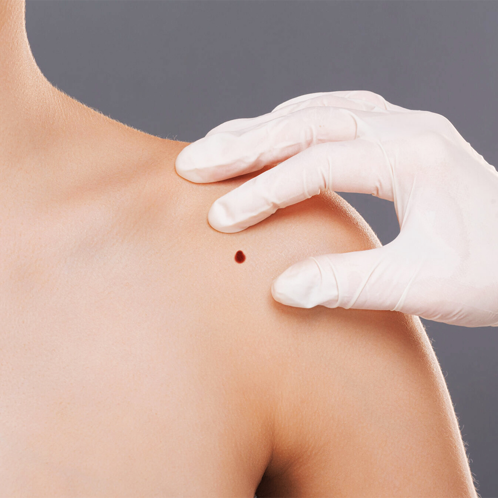 Aesthetician carefully examining a skin irregularity on a patient's skin, prepping for Lamprobe treatment.