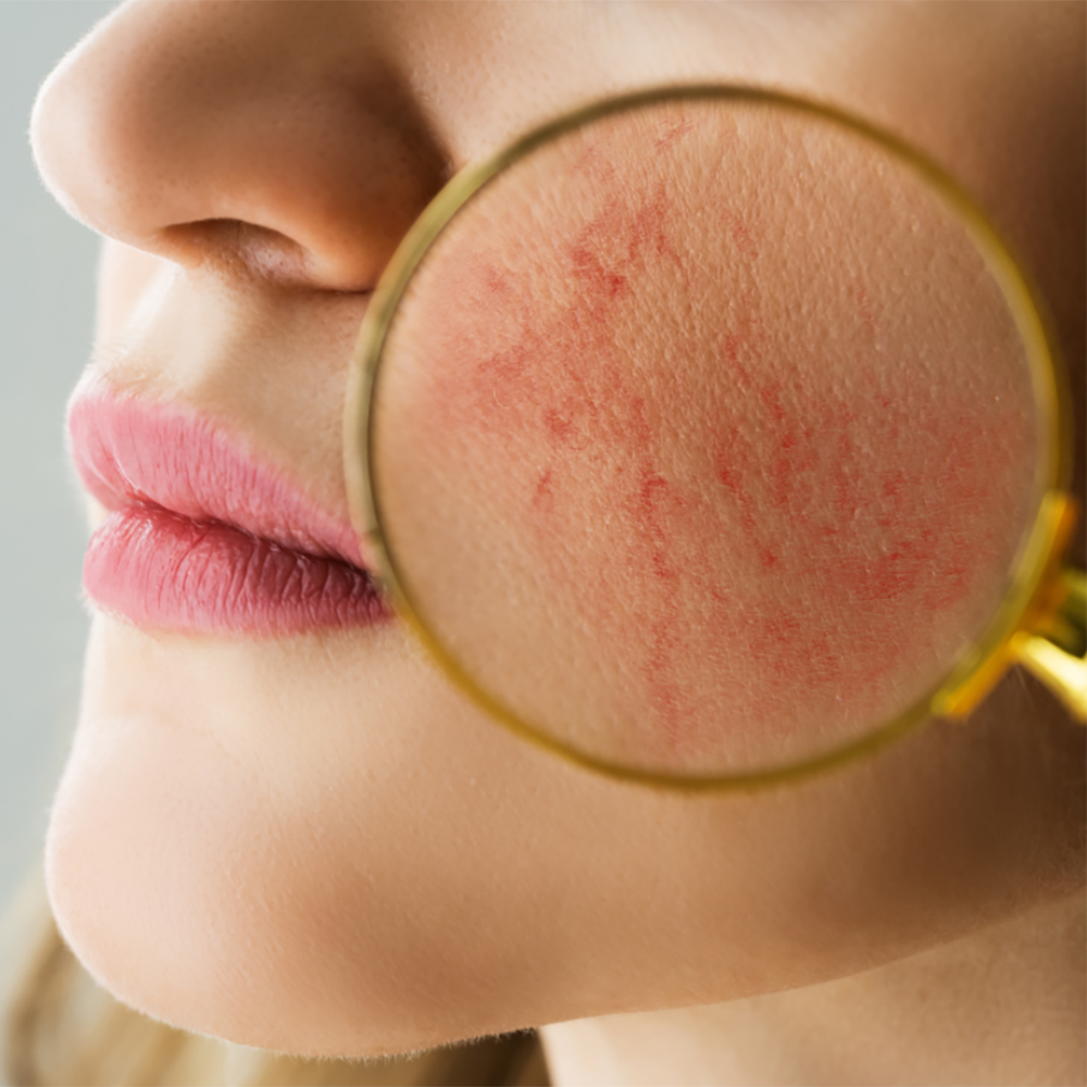 Detailed image of facial thread veins on a woman's cheek, showcasing the treatment focus at Janine's Skin & Laser Clinic.