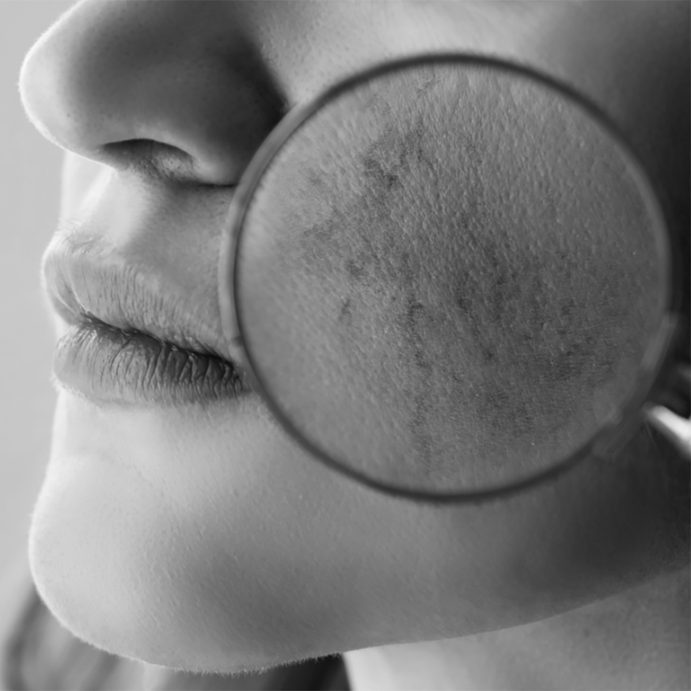 Close-up of a woman's cheek with magnifier overlay illustrating facial thread veins for the Thread Veins treatment page.