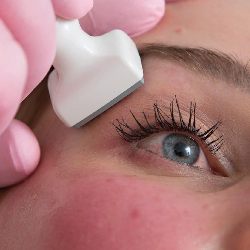 Close-up image of the AQ DermaStamp being applied to a patient's face during a GFIT treatment.