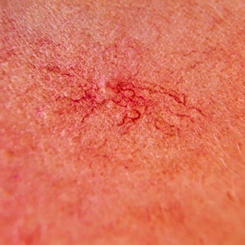 Close-up of skin lesions being treated with the Lamprobe device at Janine's Skin & Laser Clinic, highlighting the effectiveness in addressing vascular and sebaceous lesions.